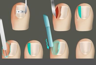 Αφαίρεση του καρπού παρουσία μυκήτων στα πόδια