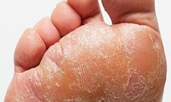 Σημεία και συμπτώματα μύκητας στα πόδια