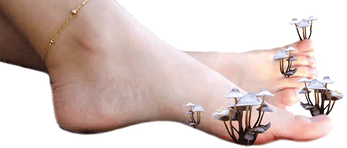 μύκητας στα πόδια